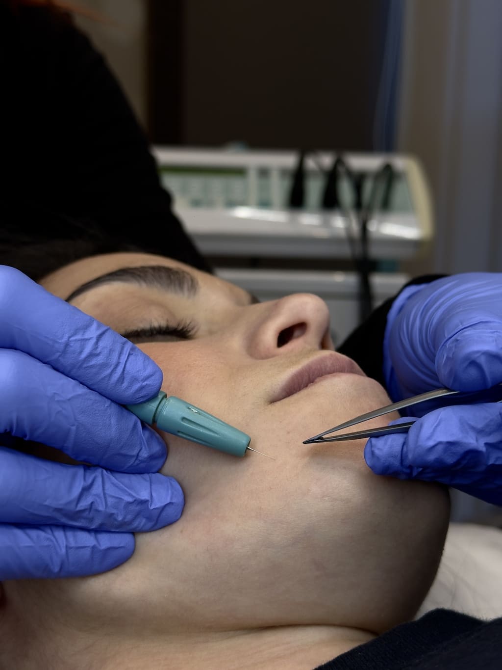 ριζική αποτρίχωση